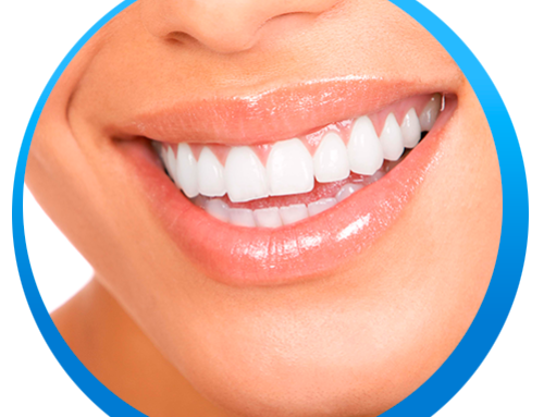 ¿Estás pensando en realizarte un blanqueamiento dental?