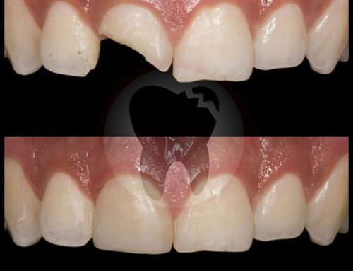 ¿HAS PERDIDO PIEZAS DENTALES EN UN ACCIDENTE DE TRANSITO?