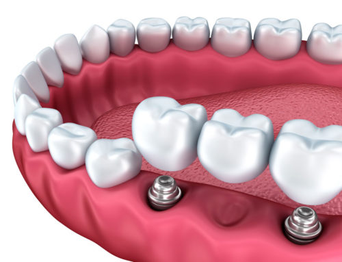 LAS PRÓTESIS, UNA ALTERNATIVA PARA RECUPERAR SU SONRISA
